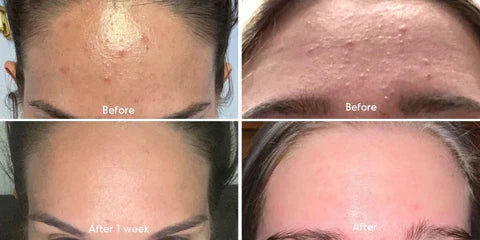 Acne Clearing Bundle with 2% Salicylic Acid & Niacinamide